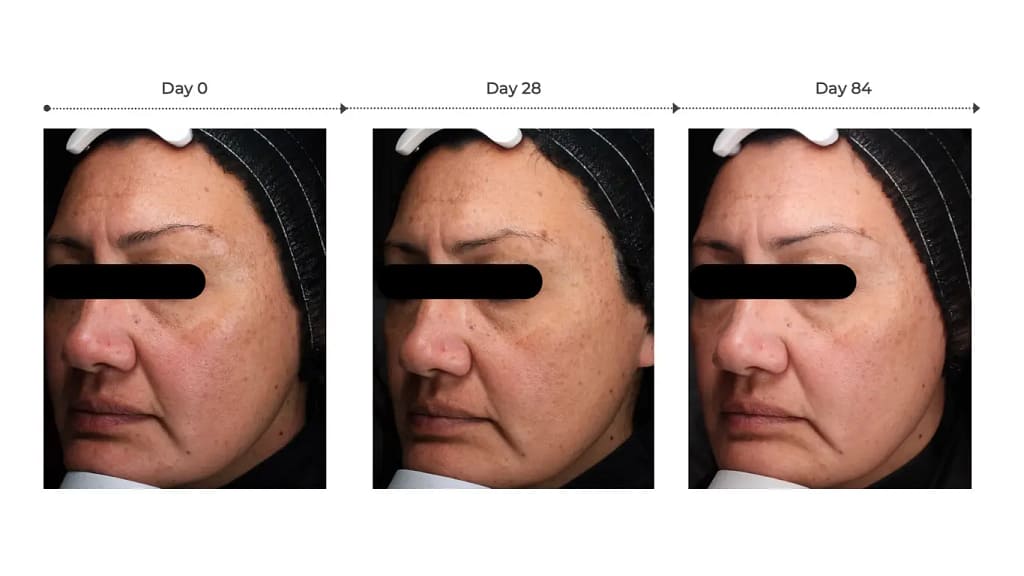 before and after photo for dark spots